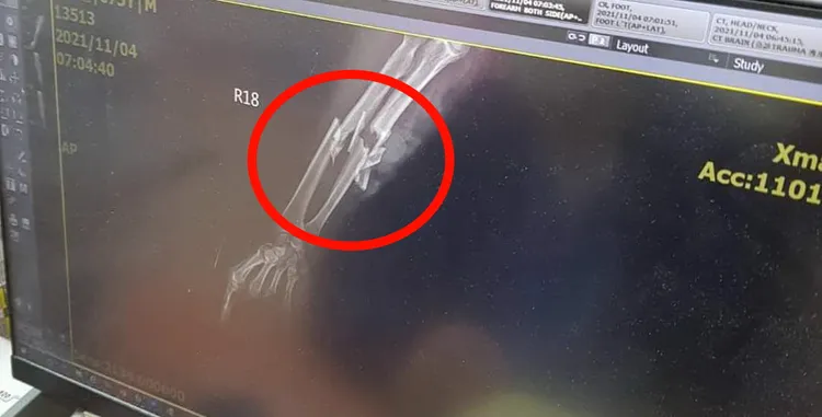 諶翁用雙手抵擋，兩隻手都被打到骨折。翻攝照片