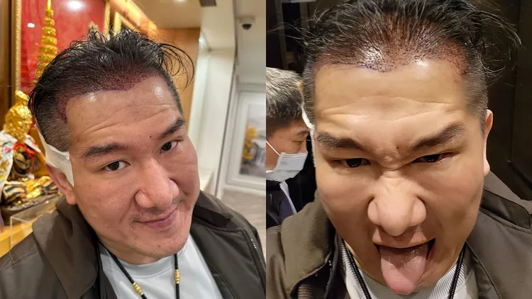 館長近期完成植髮手術。翻攝臉書粉絲頁《飆捍》