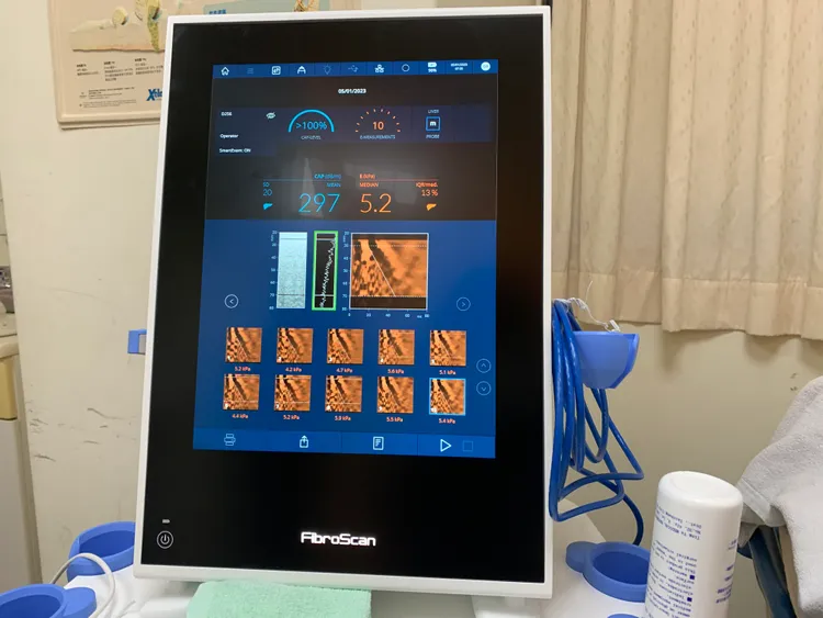 新型的「非侵襲性肝纖維化掃描儀」(Fibroscan) 可同時得知肝臟纖維化程度及肝脂肪含量。門諾提供