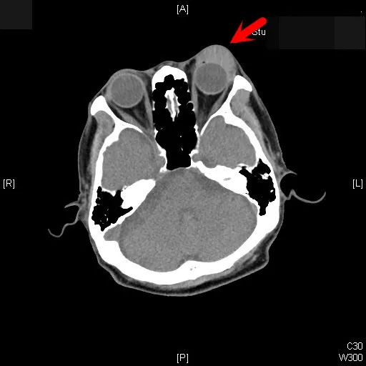 電腦斷層影像中，可看見大叔左眼明顯往外凸。張丞賢醫師提供