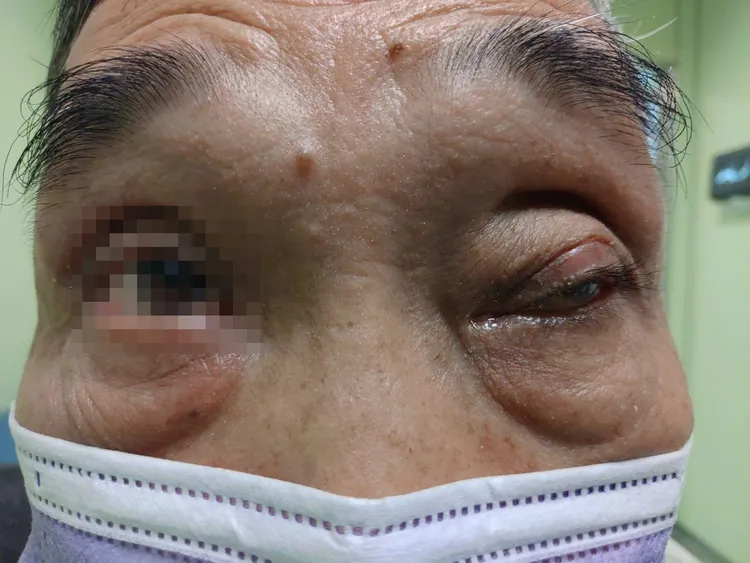 大叔經開刀進行腫瘤摘除手術，術後已略能睜開左眼。張丞賢醫師提供