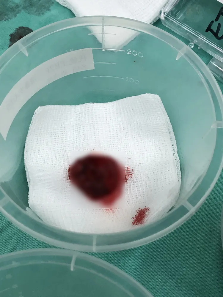 張丞賢從大叔左眼後方摘除一顆如如乒乓球的腫瘤，病理證實是「眼窩淋巴癌」。張丞賢醫師提供