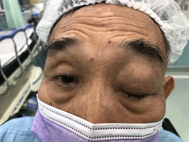 大叔就醫時，因左眼後方長有腫瘤，左眼無法睜開。張丞賢醫師提供