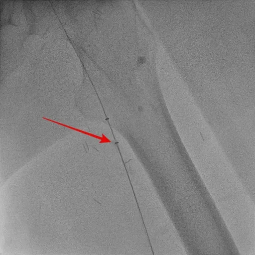 醫師利用機械性血栓抽吸導管移除血栓。亞大醫院提供