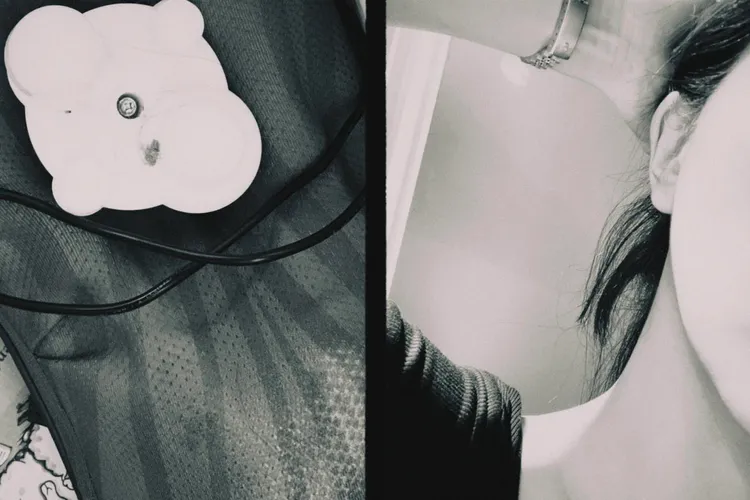 為了搶救頭皮，周曉涵只好剪去頭髮。翻攝自周曉涵臉書