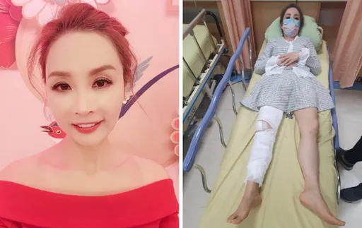名嘴許聖梅跌倒軟骨碎成兩半　傷勢照曝光