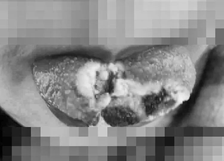 6歲女童的舌頭有3度嚴重燒燙傷。翻攝畫面