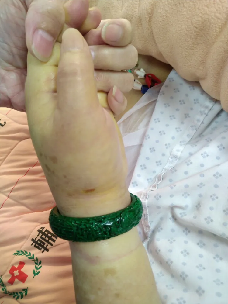 張黃姓婦人手鐲卡住導致左手腕腫脹。新北市消防局提供