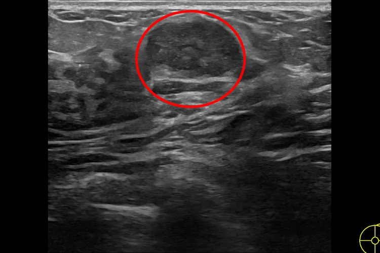 良性乳房纖維瘤。花蓮慈濟醫院提供