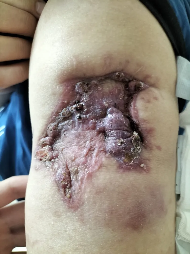 一名40歲女性打完疫苗手臂紅腫化膿。資料照片。翻攝蘇一峰臉書