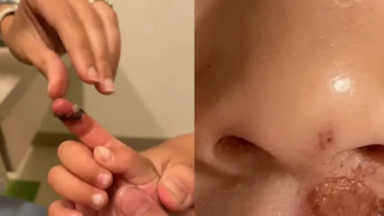 張恆稱女兒手指的傷口和兒子鼻子下疑似被菸燙傷的傷疤，都是在鄭爽照顧期間受的傷。翻攝張恆微博