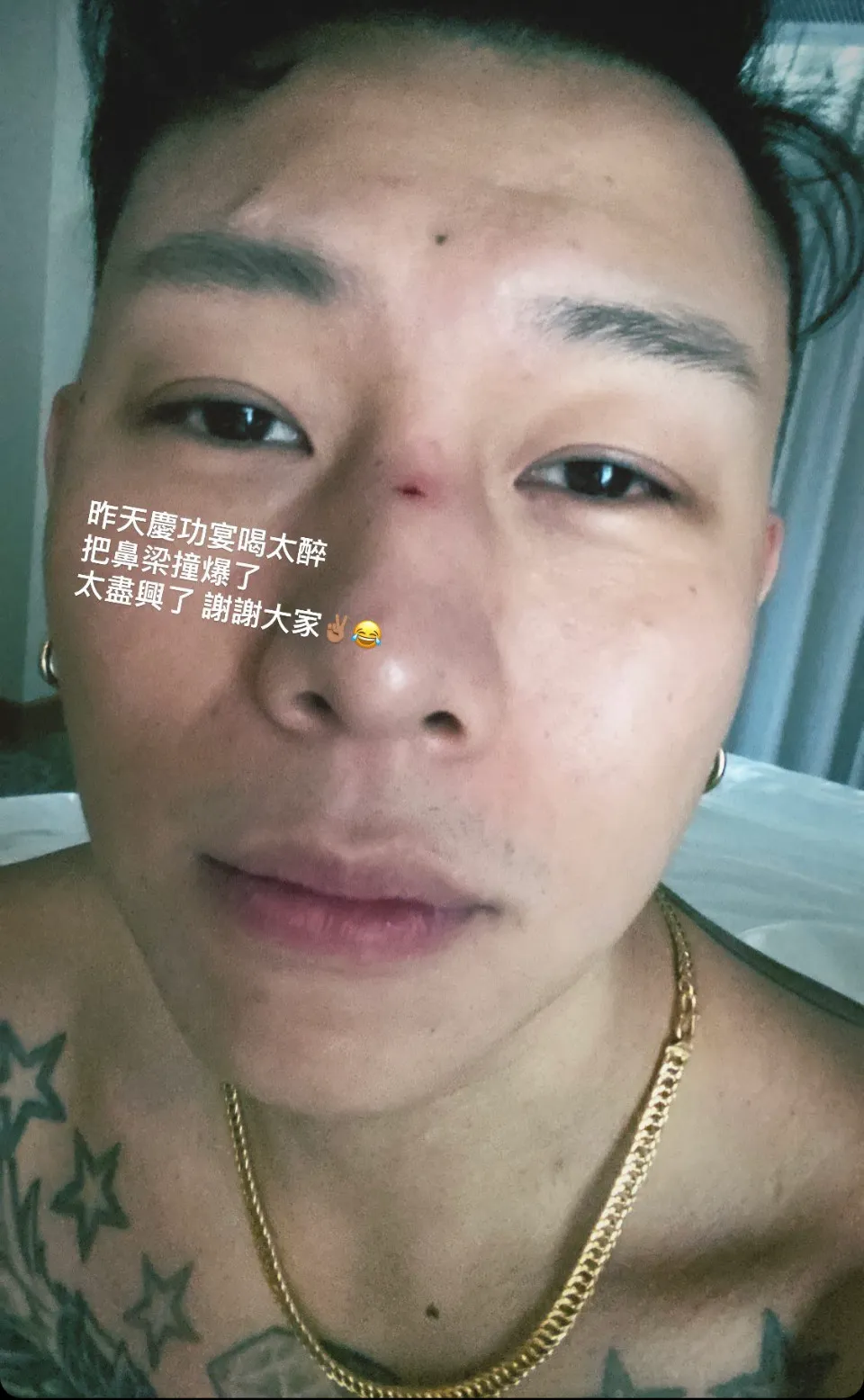 瘦子慶功宴喝太嗨,撞傷鼻樑。翻攝瘦子IG