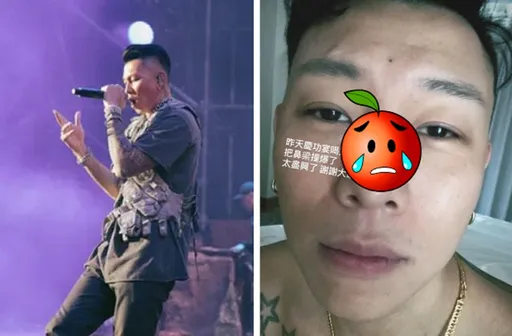 瘦子喝太醉帥臉破相 撞爆鼻樑傷口照曝光