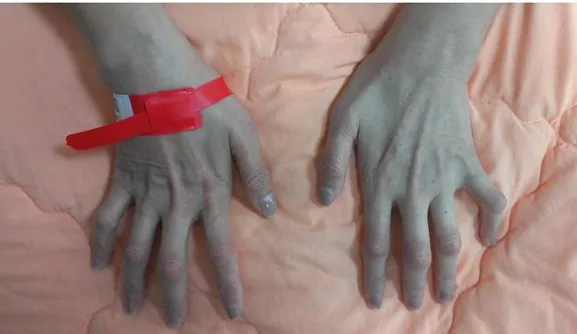 急性紫質症未接受適當治療造成嚴重周邊神經病變。中榮提供