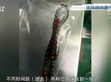 女童的手術後取出多達61顆俗稱「巴克球」的磁力珠。翻攝微博/浙江大學醫學院附設兒童醫院