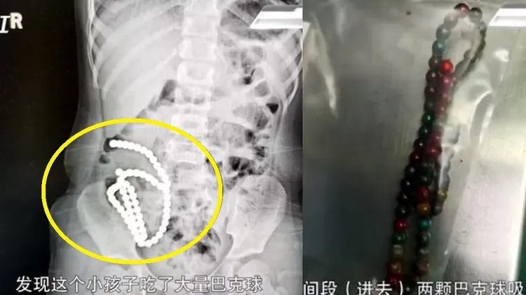 女童的腹部X光有約一公尺長的白點（左圖），手術後取出多達61顆俗稱「巴克球」的磁力珠（右圖）。翻攝微博/浙江大學醫學院附設兒童醫院