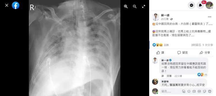 返台台商確診後呈現嚴重肺炎的大白肺。翻攝自蘇一峰臉書