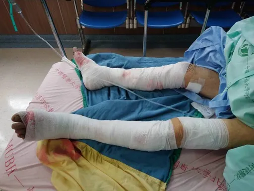 雲林老婦遭狗圍攻住院40天　傷口深可見骨！飼主判賠138萬元