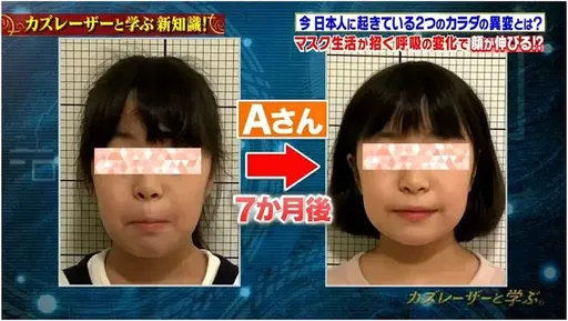 長期戴口罩讓臉塌陷變長　醫曝恐怖後果「看起來特別老」