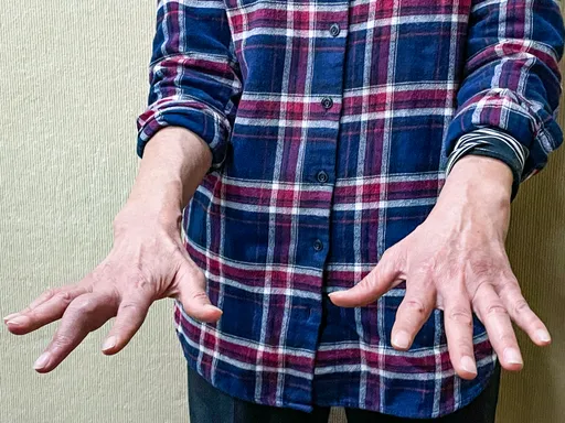 類風濕關節炎不再只能用貴鬆鬆西藥 北榮「這一包」泡10分鐘速改善