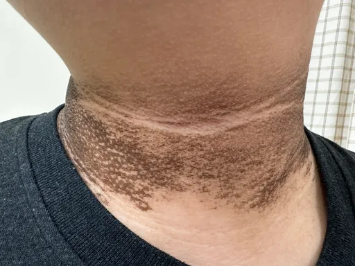 國三男體重124公斤險爆肝 脖子驚見黑色棘皮!用藥減重拾回健康