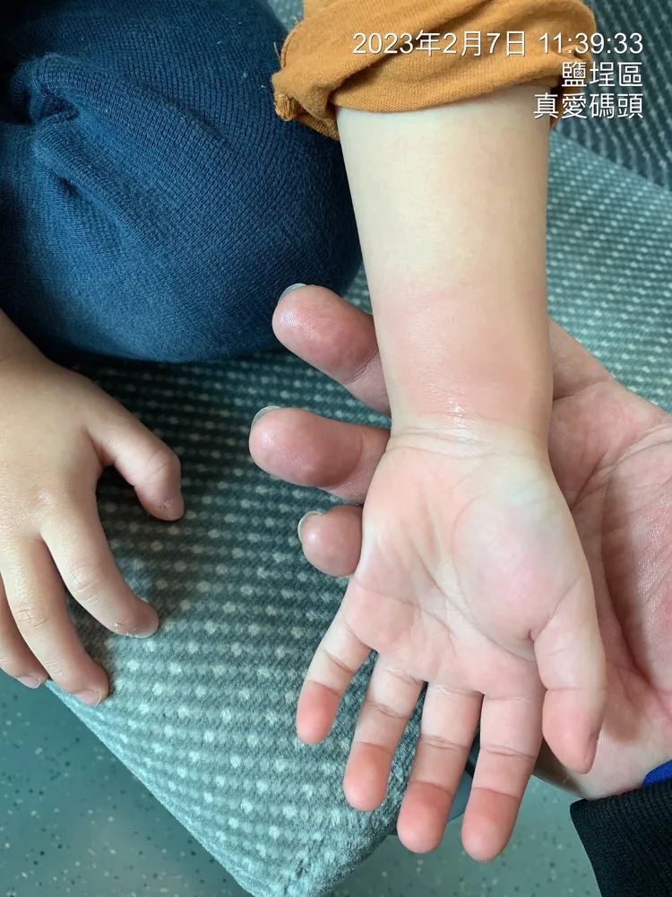 小男童經救援抽出左手後，左手仍有紅腫現象。讀者提供