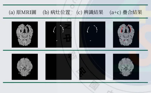 強到不像國中生!「多發性硬化症」奪科展獎被質疑代筆 本尊發聲了