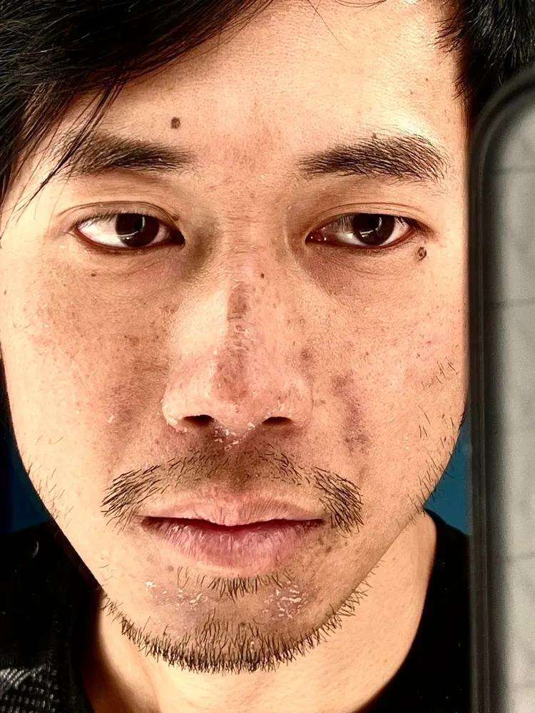 陳彥博臉部些微凍傷，全身關節痠痛。翻攝自陳彥博臉書