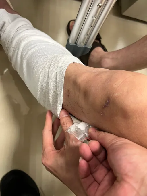 毒蟲躲驗尿裝行動不便 「黃金左腳」石膏有貓膩!藏毒遭識破被逮