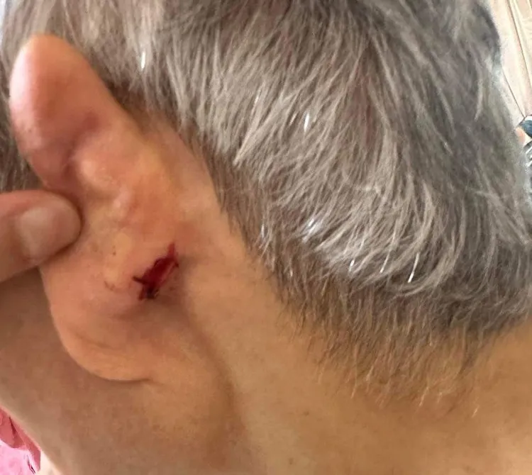 老婦人耳後流血。投訴人提供