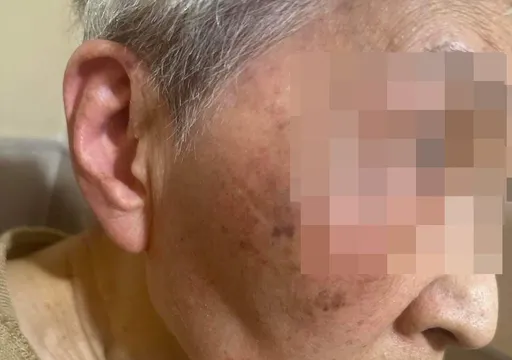 妇住院被暴打「脸瘀青耳流血」！竟是麻醉师女儿家暴　邻床怒：看不下去