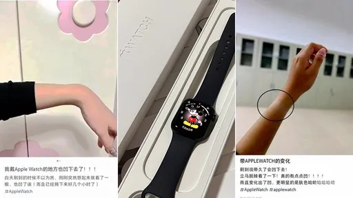笑死！Apple Watch用戶抱怨「手腕凹陷」　讓客服醫師都傻眼