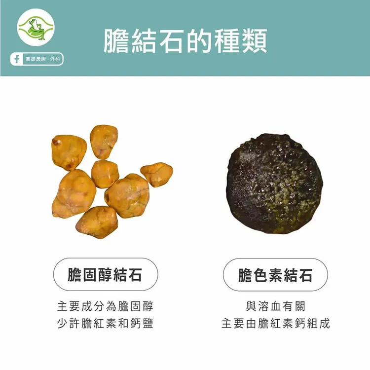 膽結石。來源：高雄長庚醫院