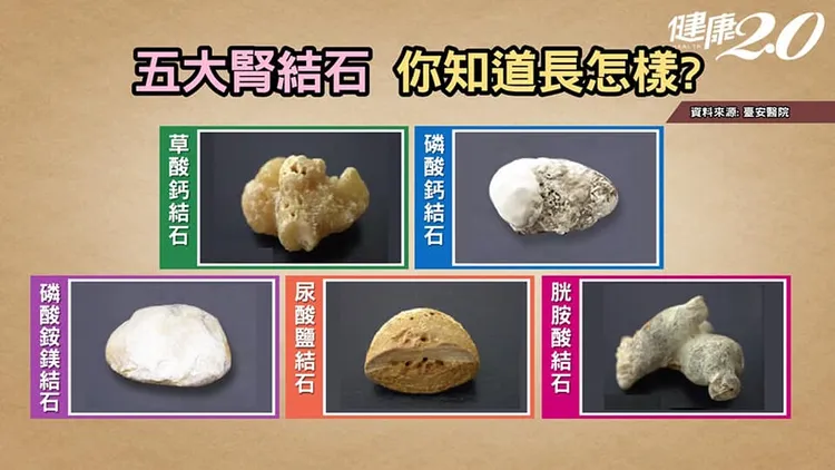 腎結石。來源：台安醫院