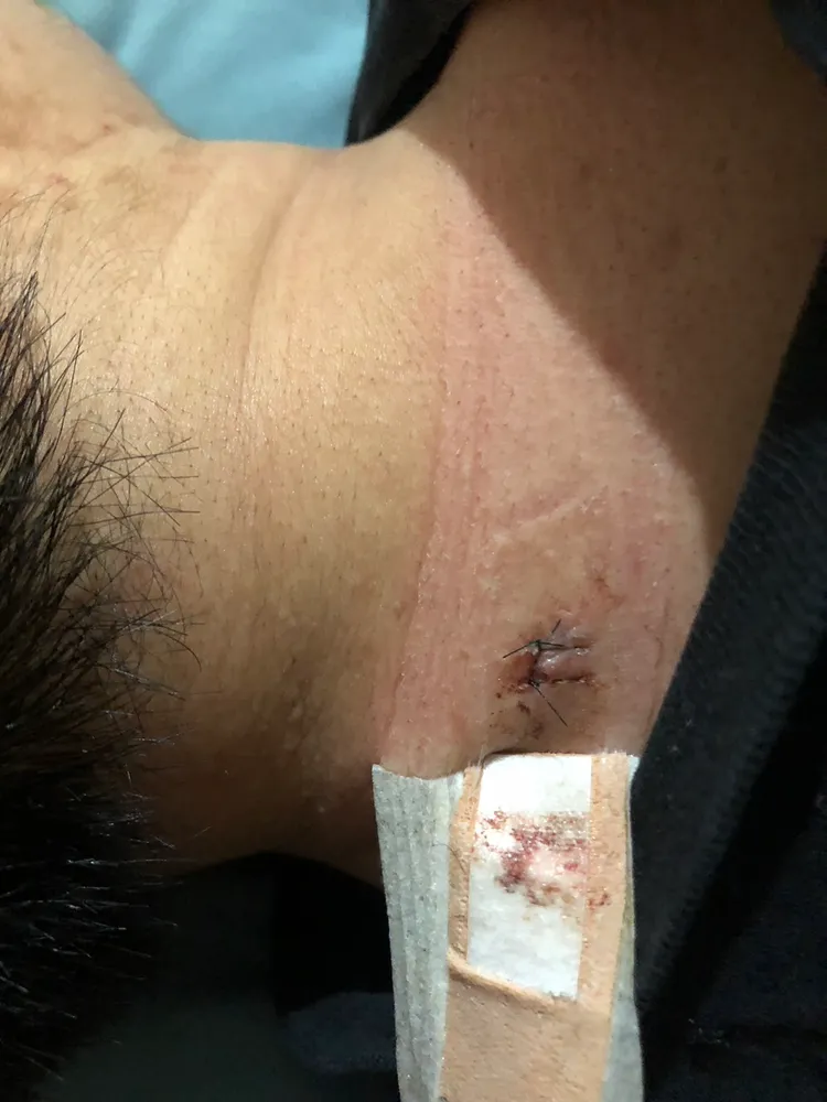 陳男被酒瓶砸中，導致脖頸受傷。翻攝畫面