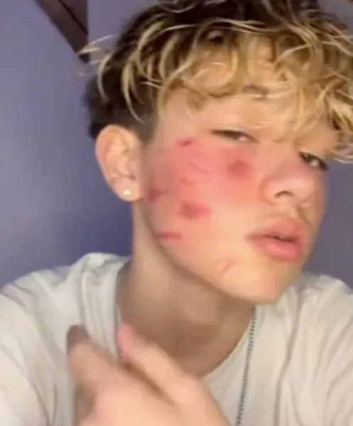 法國少年在TikTok秀出多道自虐傷痕，法國參議院通過提案，將由委員會調查TikTok的各項爭議。翻攝TikTok@Olivia_du_40