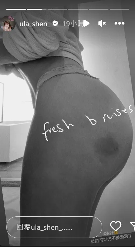 壯壯臀部瘀青了。翻攝壯壯IG