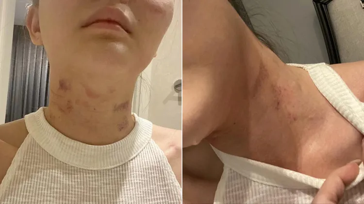 阿麗莎拉揭露過去被家暴時受傷。翻攝自阿麗莎拉臉書