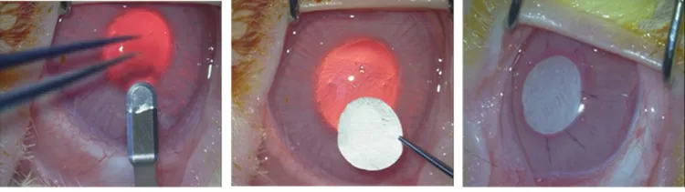 製造角膜囊袋後植入「電紡紗」人工角膜，可穩定緩釋藥物。陳偉勵提供