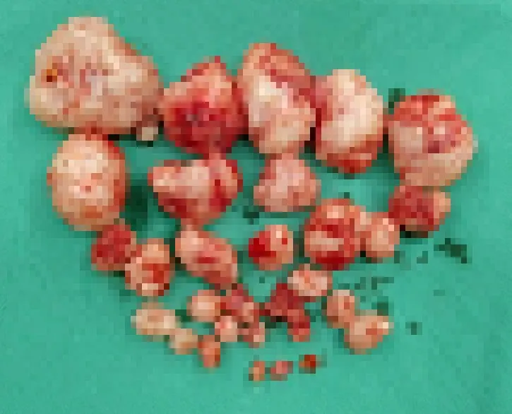 婦人子宮取出29科激流，令在場醫護看了相當心疼。光田醫院提供