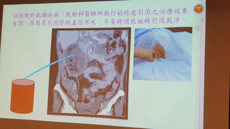 以往針對胰臟炎併發症，多由放射科醫師執行皮引流，惟治療效果有限。林芳如攝