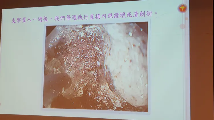 病人嚴重組織壞死，每週執行一次清創，治療兩個月才順利康復。林芳如攝