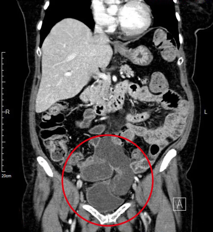 露米的骨盆腔腹膜黏液性腫瘤超過十公分。馬偕提供