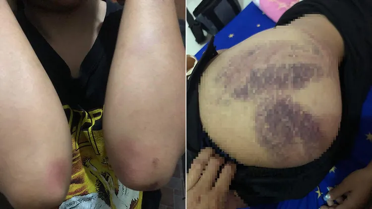 受害女員工曝光身上部分傷勢。翻攝自臉書