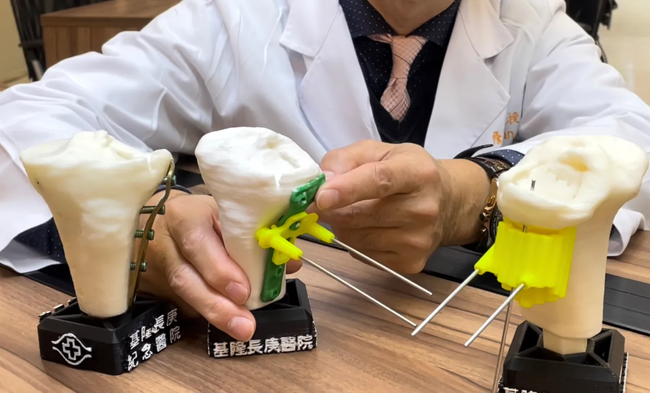 膝關節鏡輔助脛骨平台骨折精準微創復位手術示意圖。林志怡攝