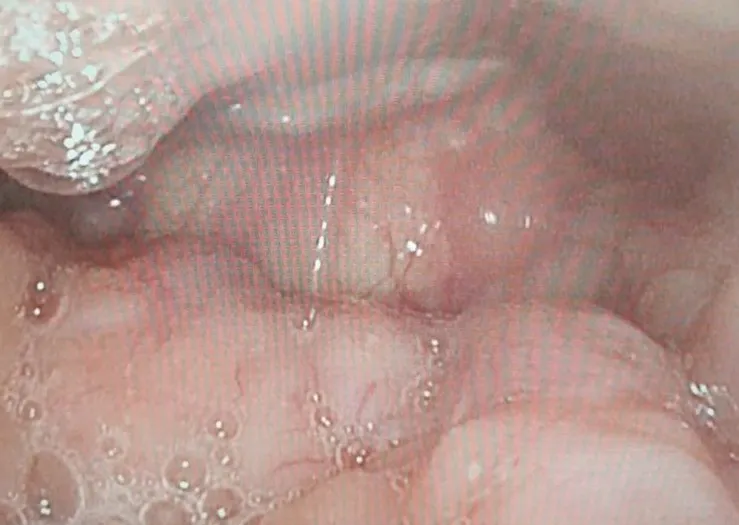 會厭軟骨塌陷造成睡眠呼吸中止。邱逢翔提供