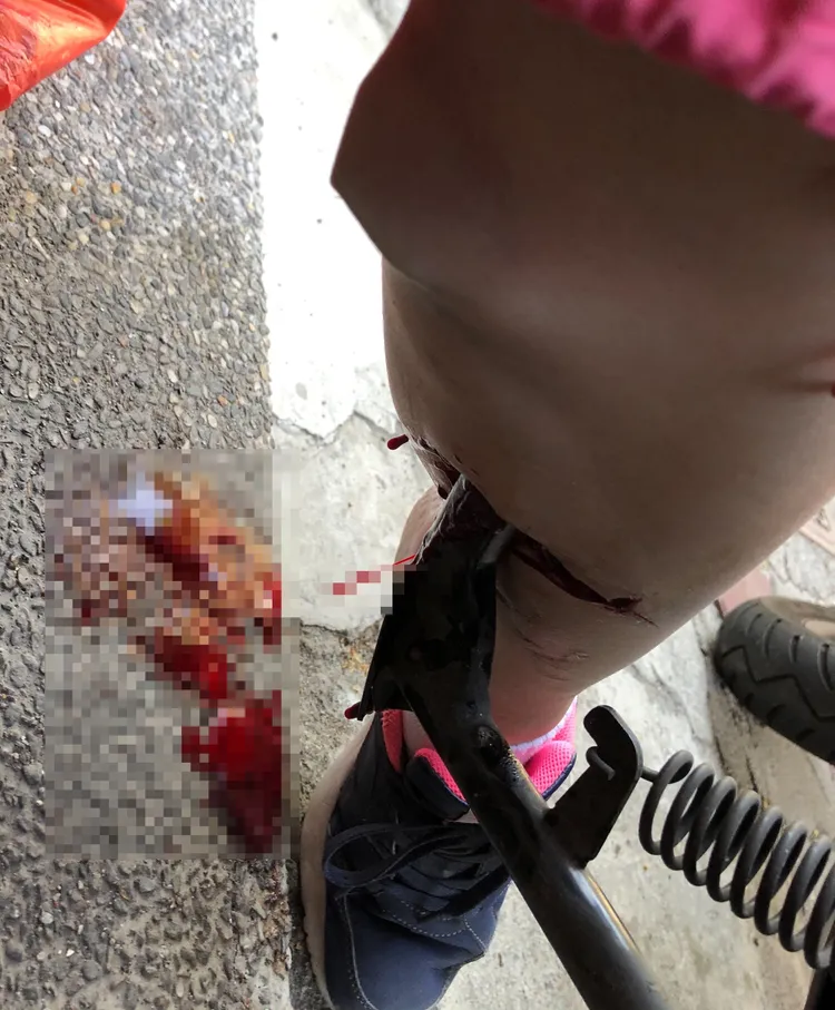 李小姐發現停機車立中柱時，車子暴衝，整隻中柱插進她的左小腿裡，濃稠的鮮血直滴。讀者提供