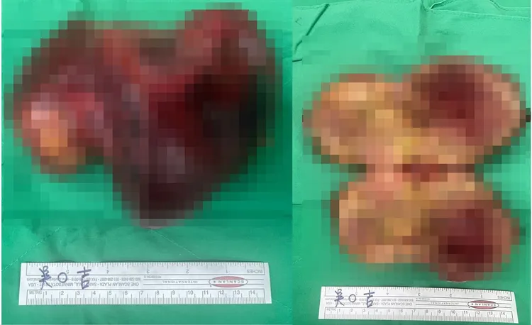 醫師切除的肝腫瘤。亞大醫院提供