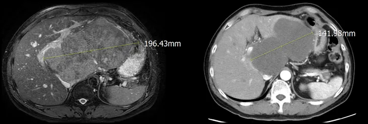 醫師檢查發現，患者左肝腫瘤有近20公分大。亞大醫院提供