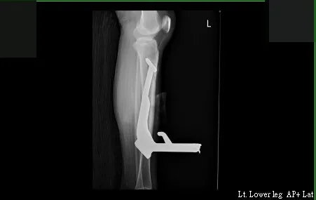 在Ｘ光片影像中，可看到長達23公分的中柱，直直插在李小姐左腿裡。讀者提供